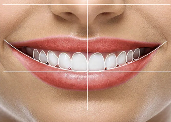 Smile Design